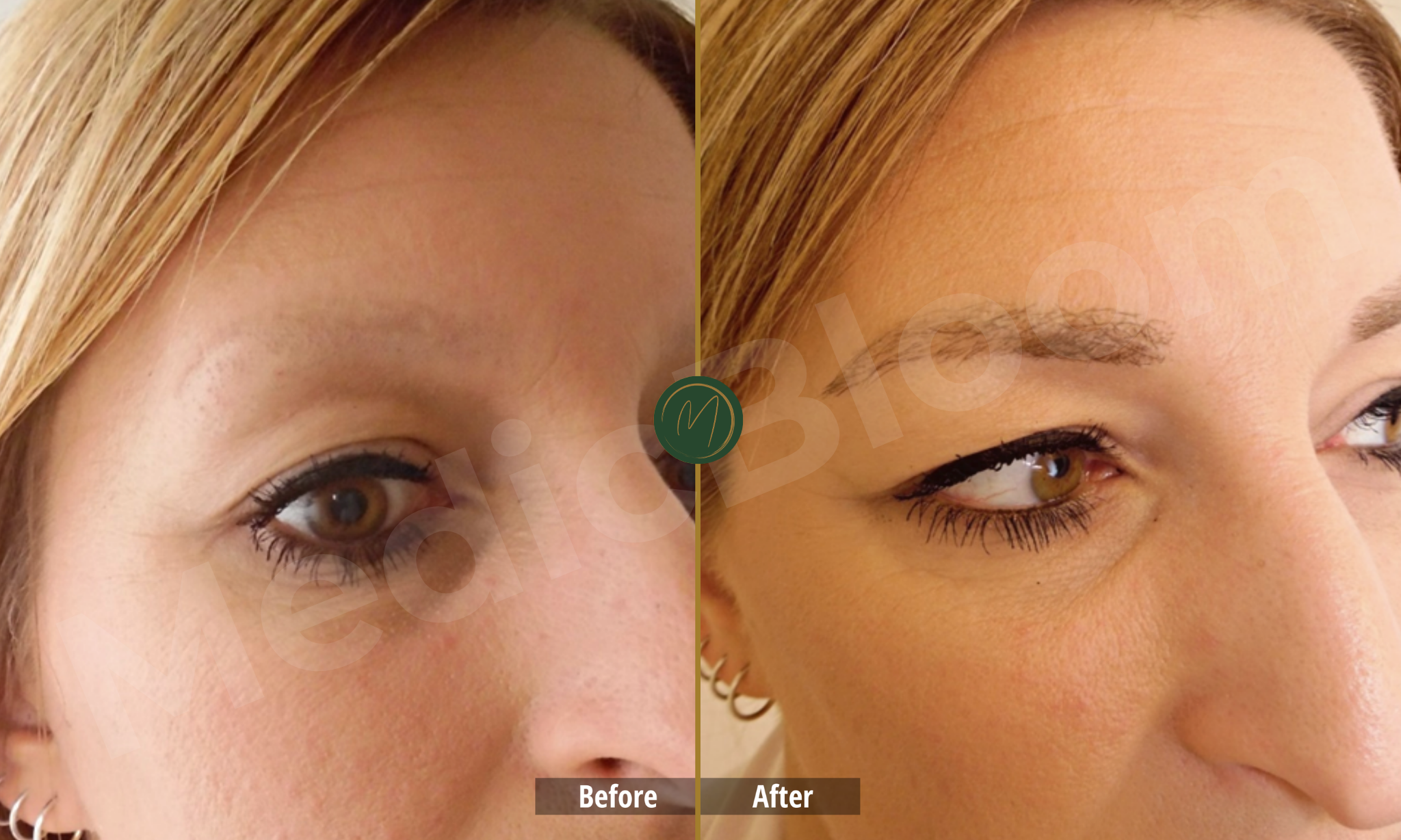 Eyebrow Restoration before and after