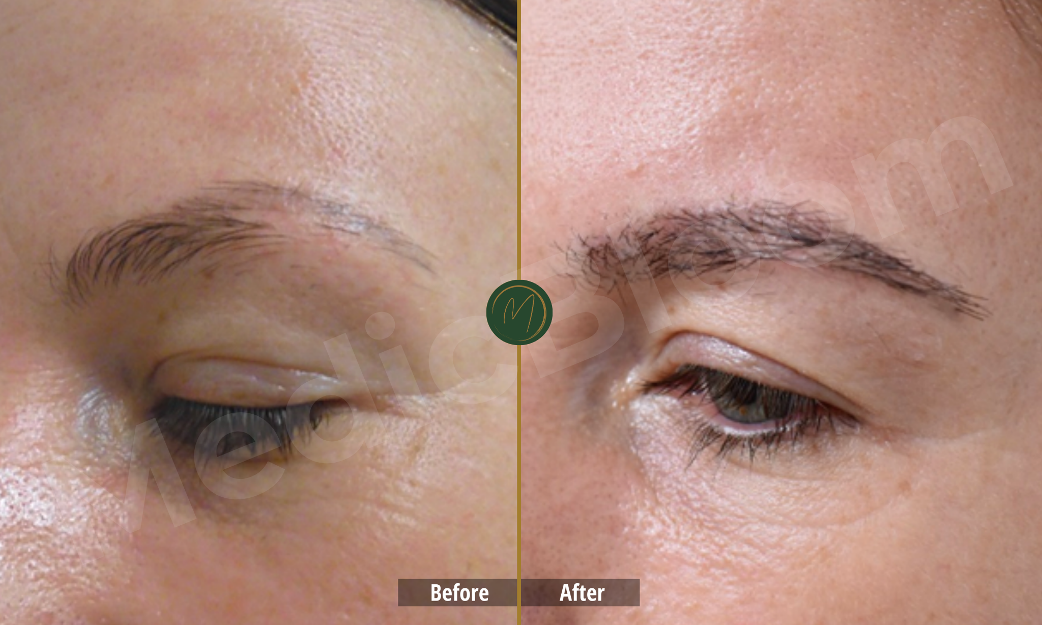 Eyebrow Restoration before and after
