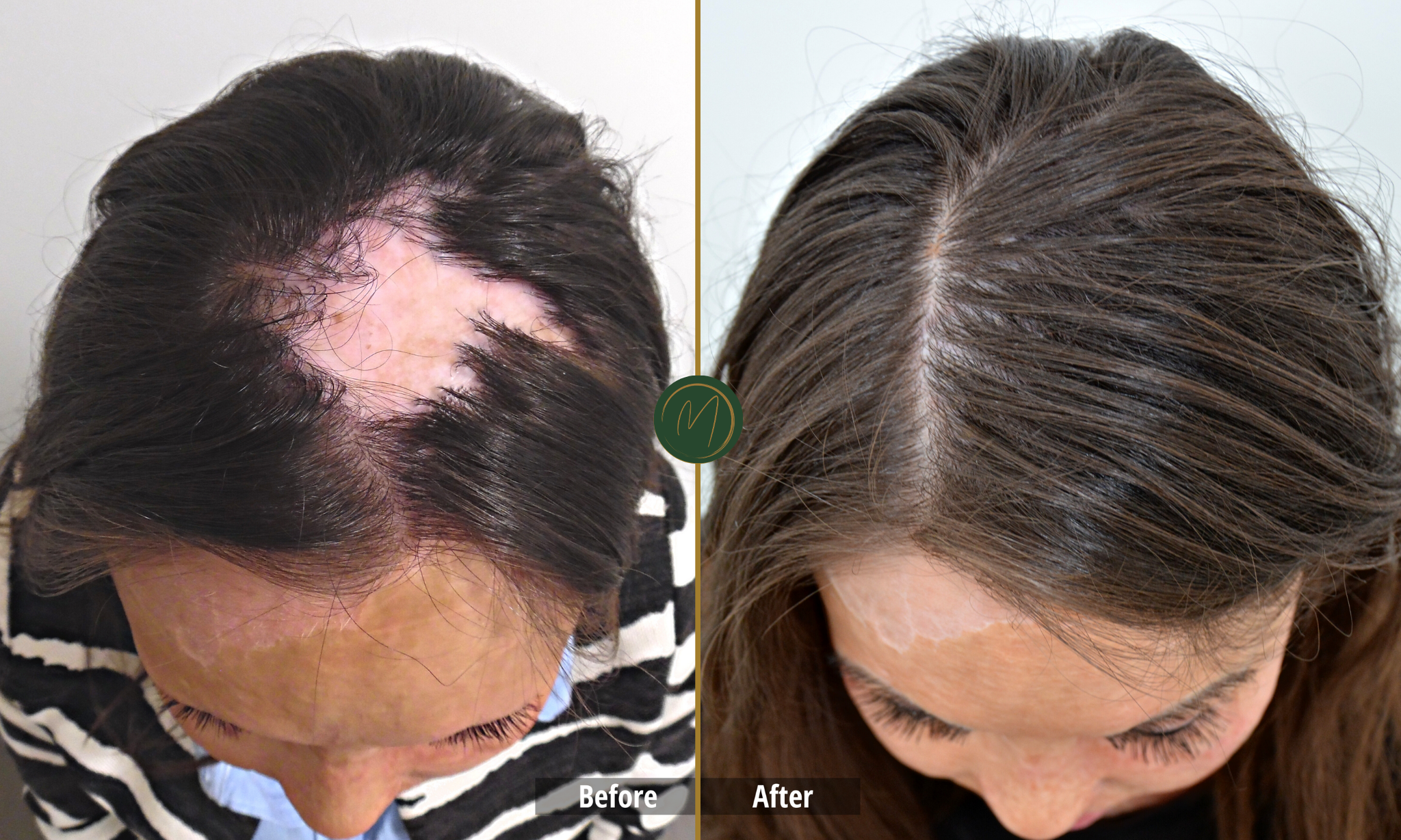 Female Hair Restoration before and after