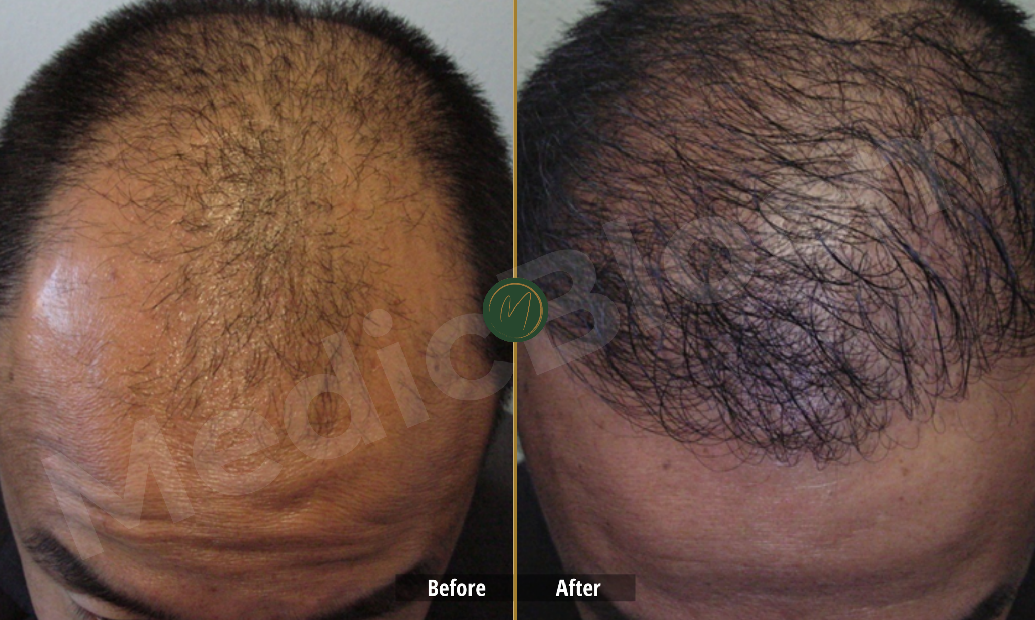 Density Restoration before and after