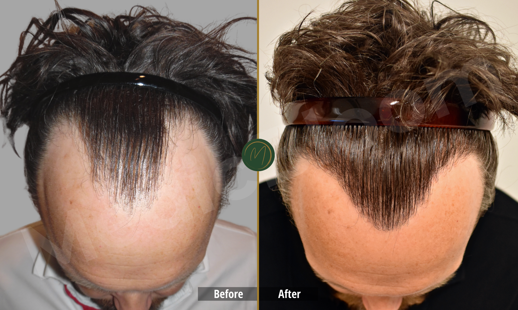 Hair restoration before and after