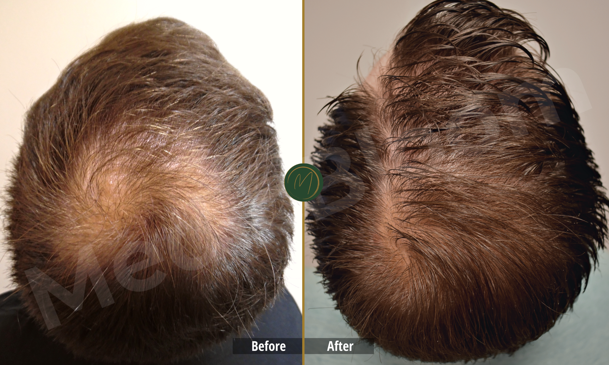Crown Restoration before and after