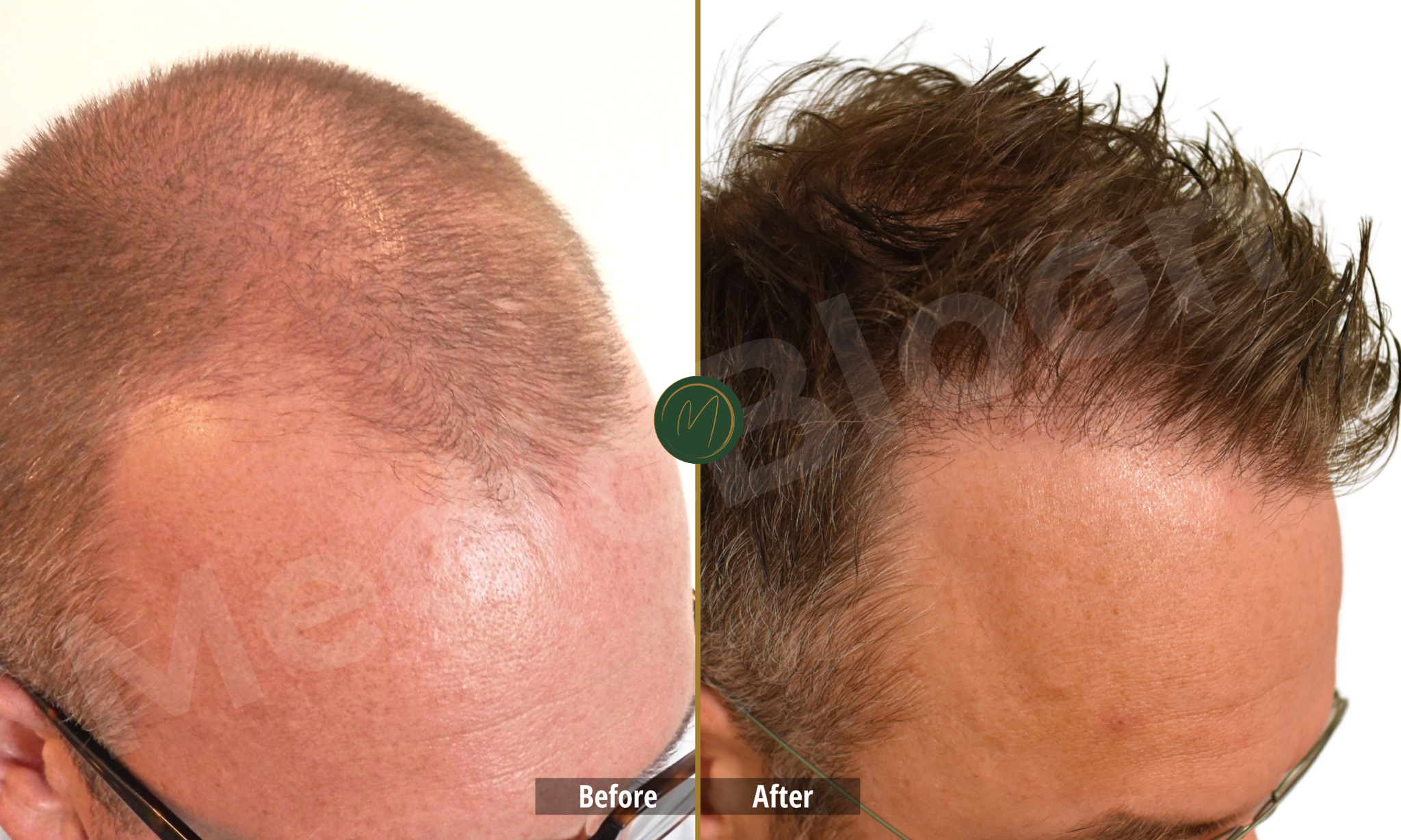 Hairline Result before and after
