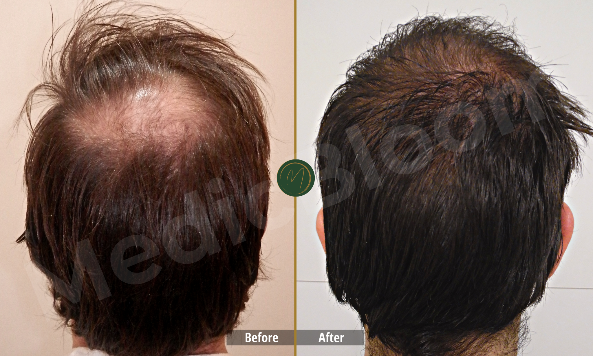Frontal Restoration before and after