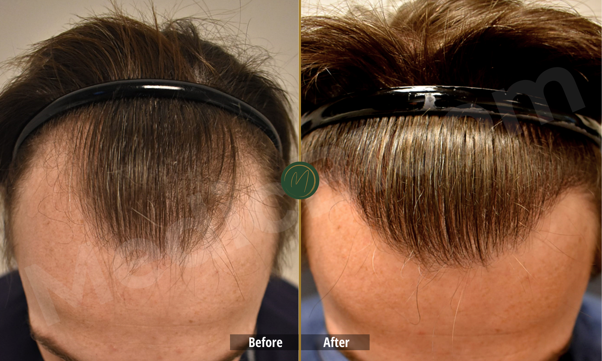 Hairline Density before and after