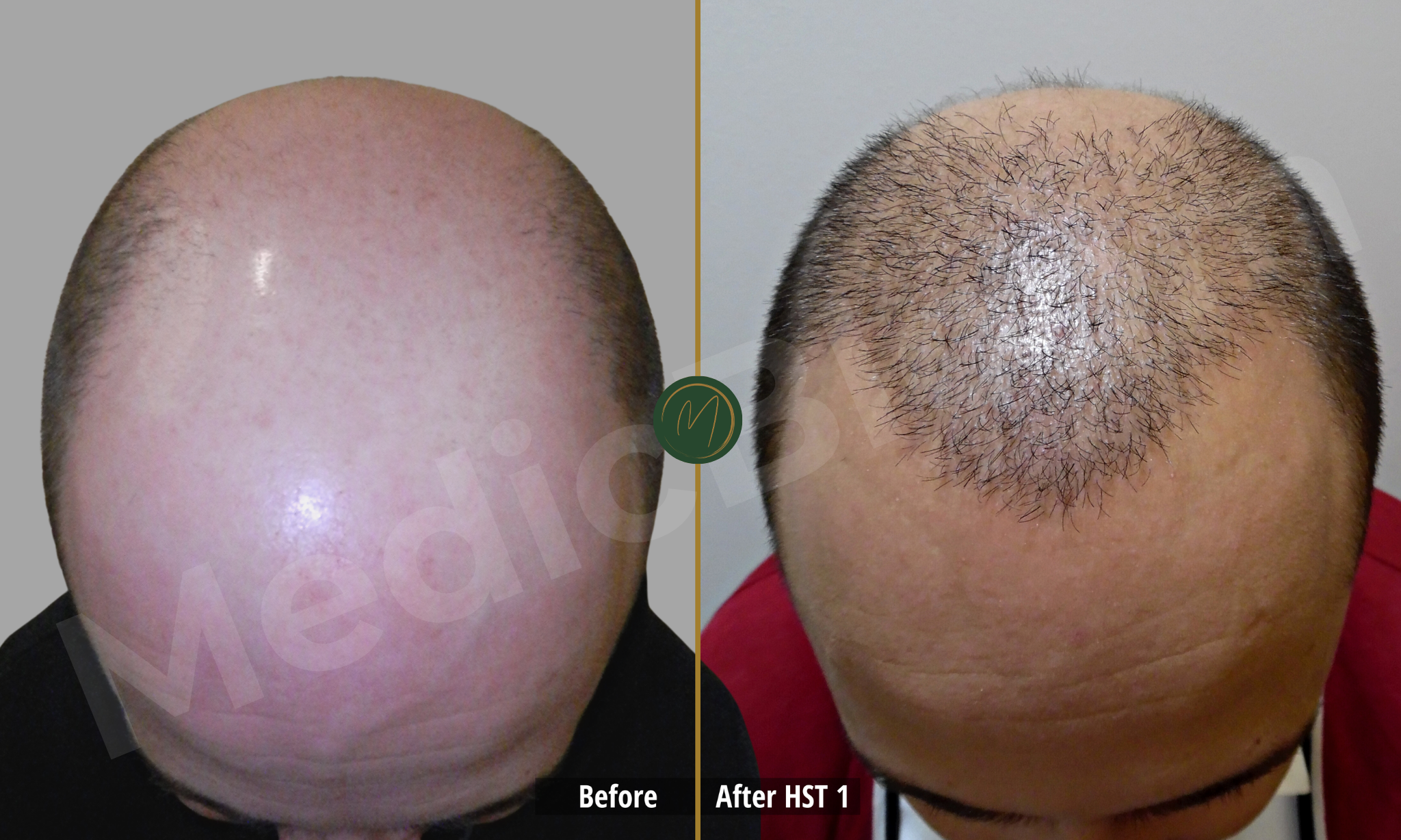 Hairline Density before and after