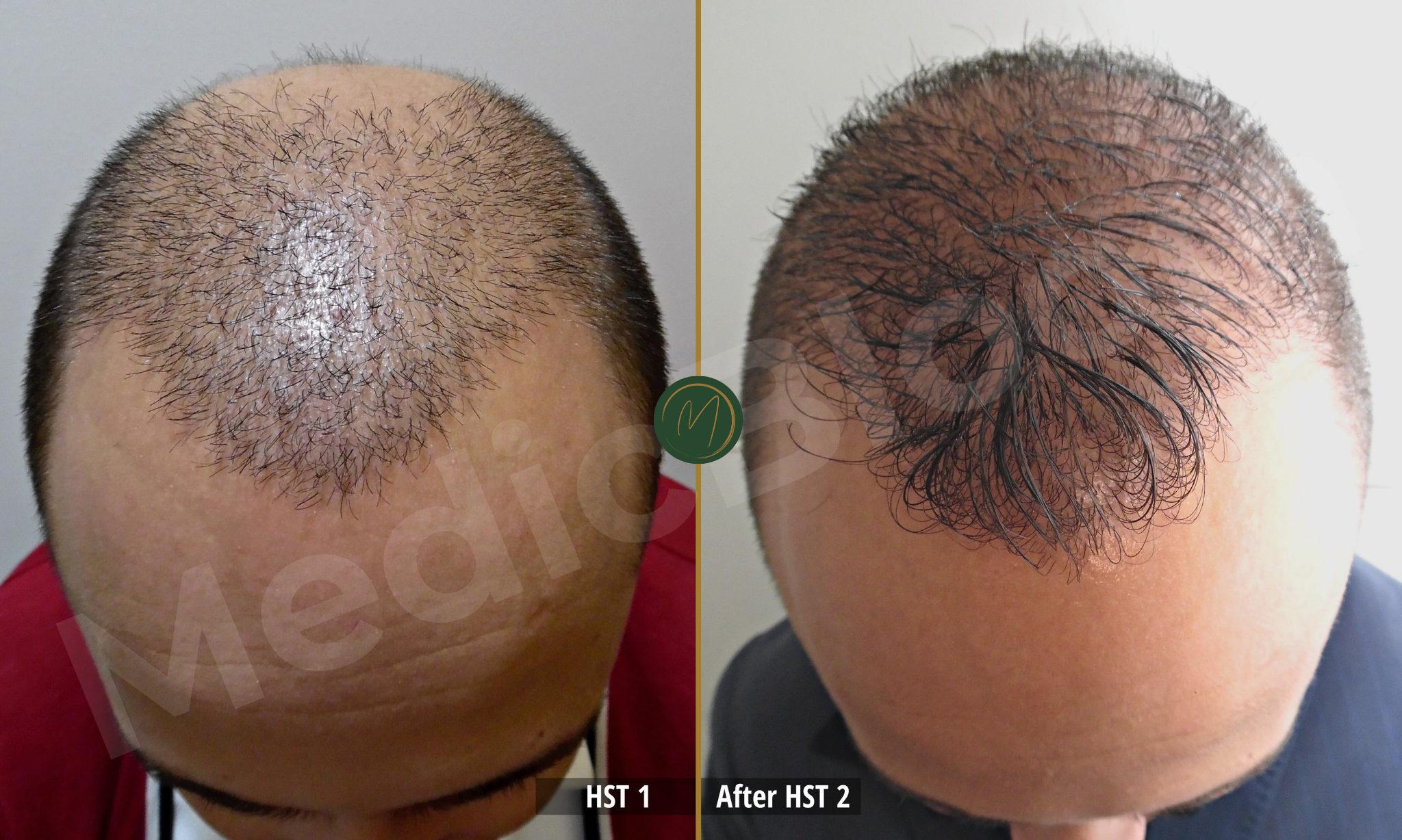 Advanced Restoration before and after