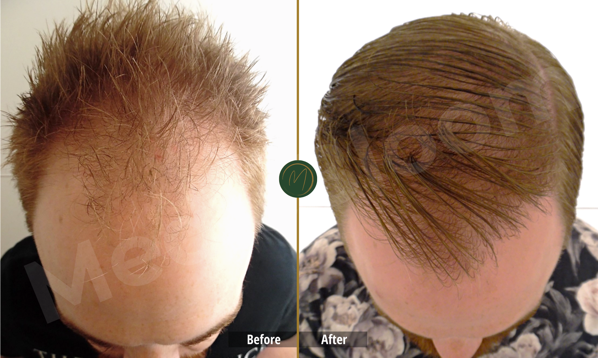 Crown Density before and after