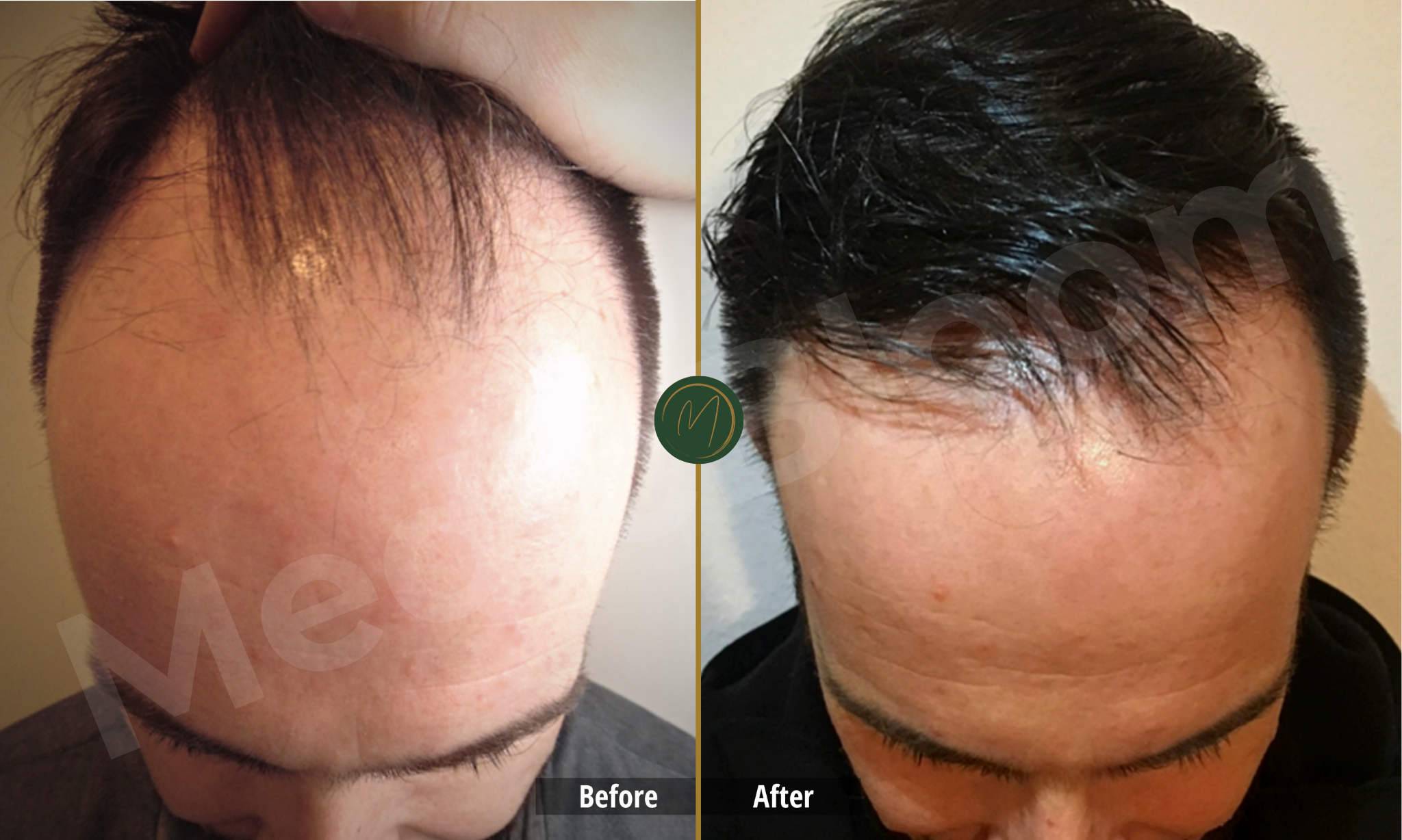 Hairline Restoration before and after