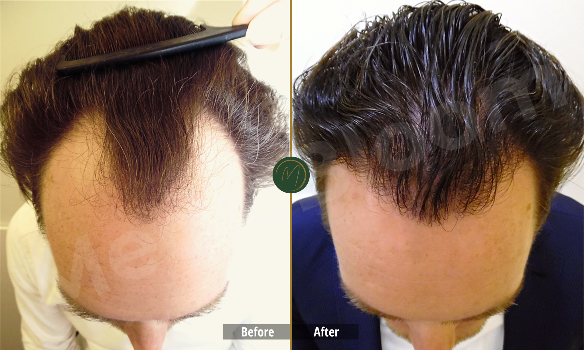 Advanced Hair Loss before and after