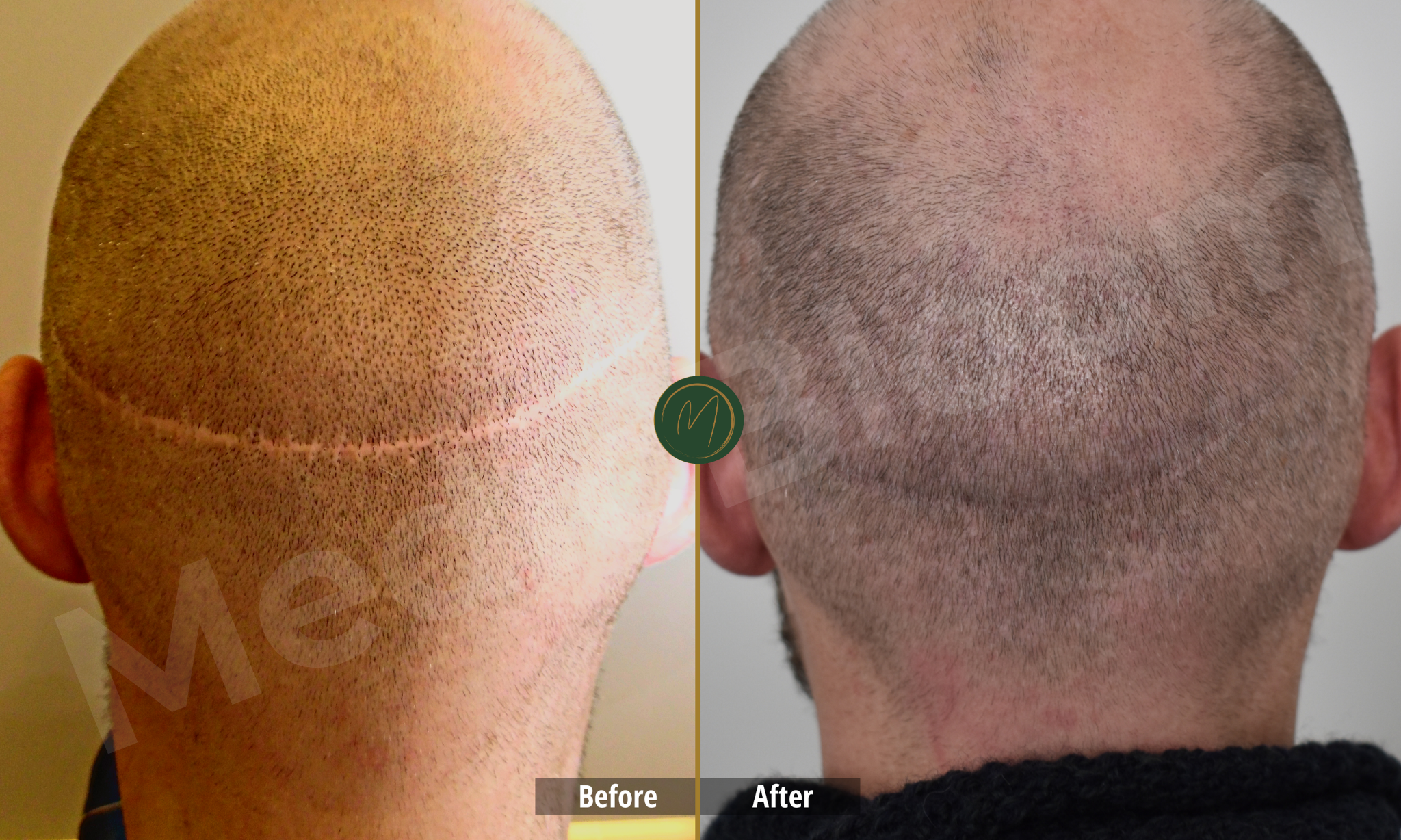 Donor Area Recovery before and after