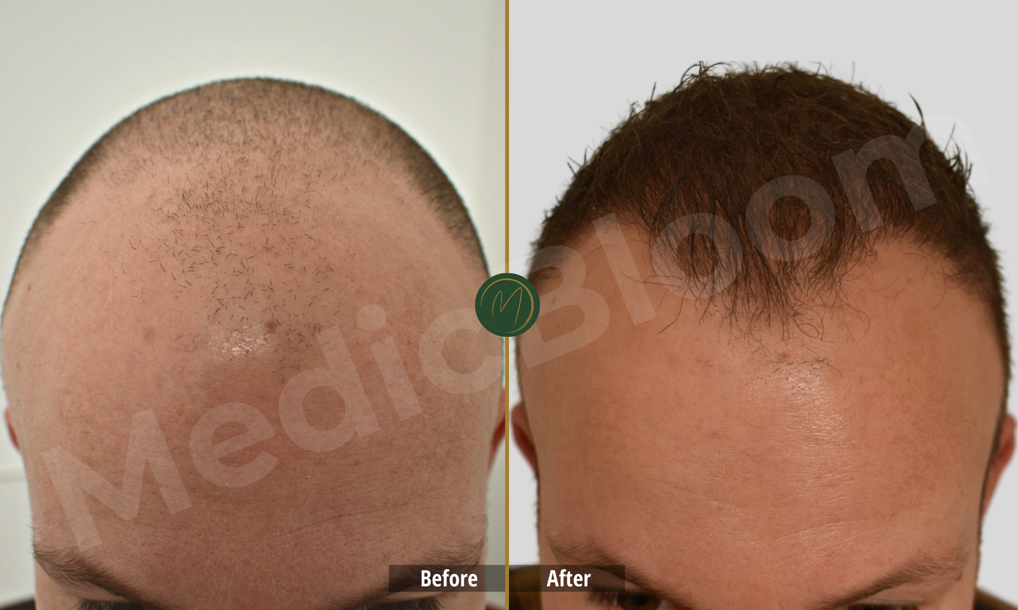 Hairline Restoration before and after