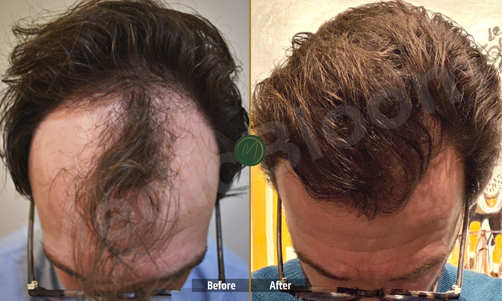 Frontal Density before and after