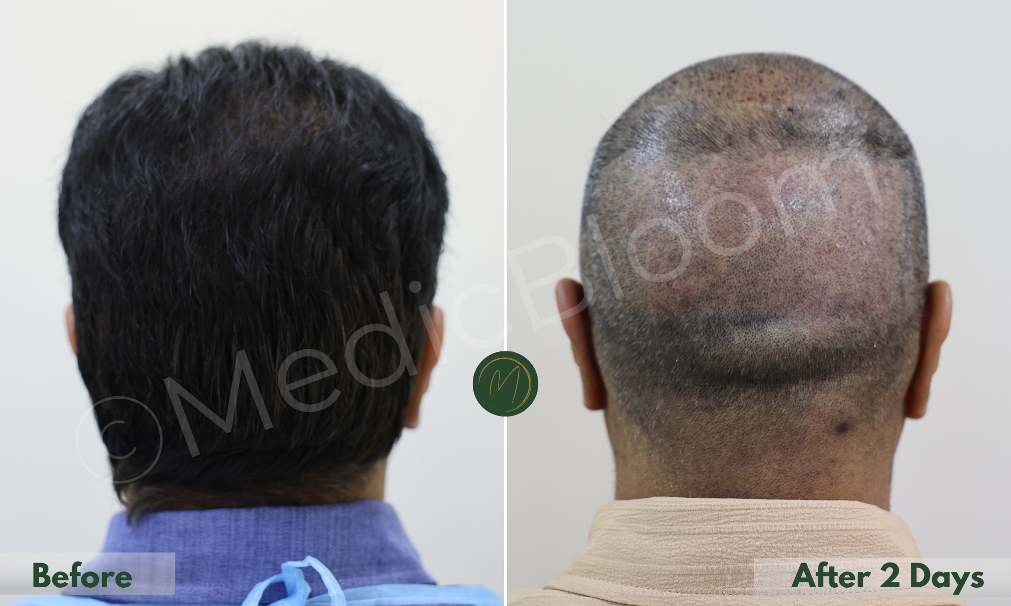 Donor Area before and after