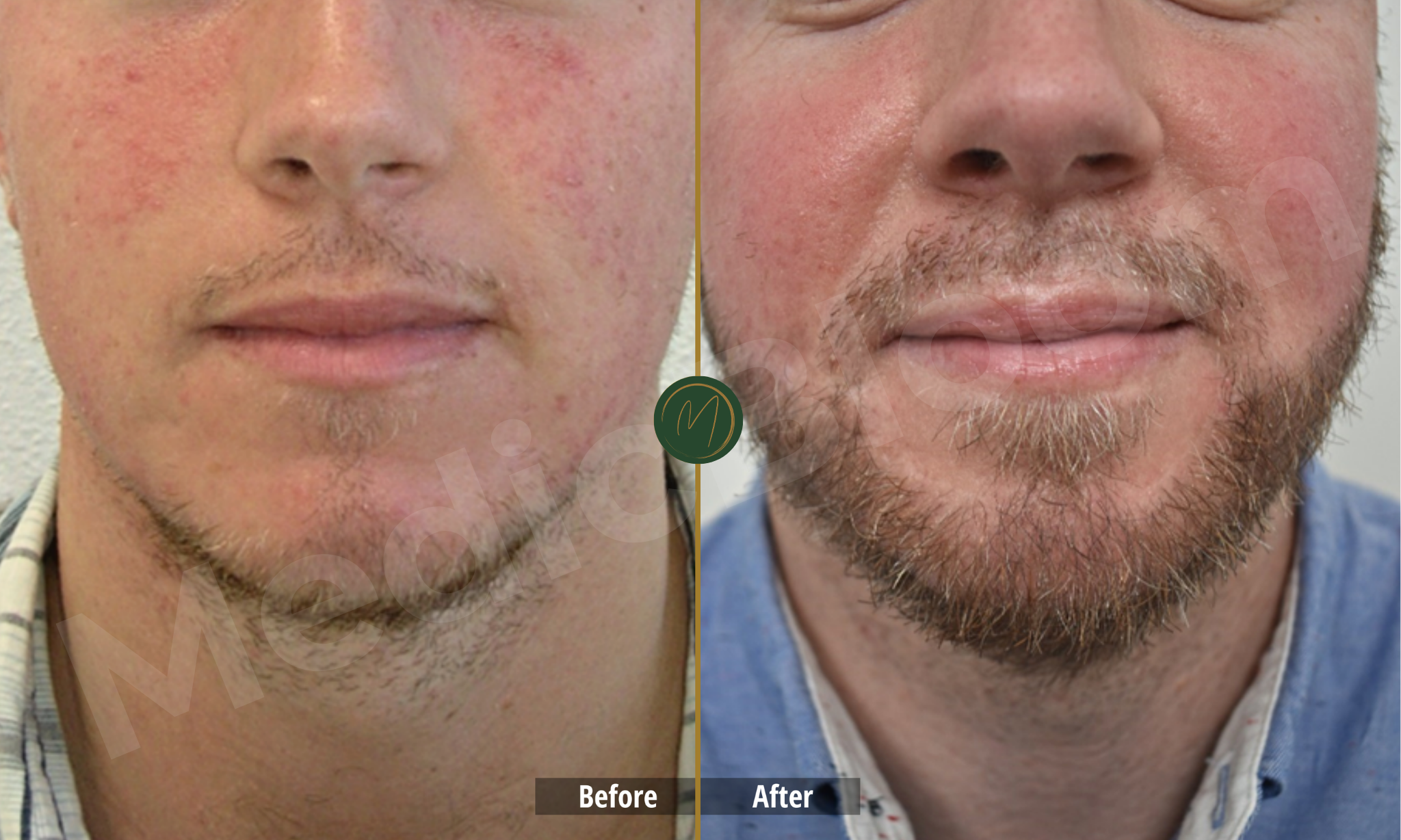 Beard Restoration before and after
