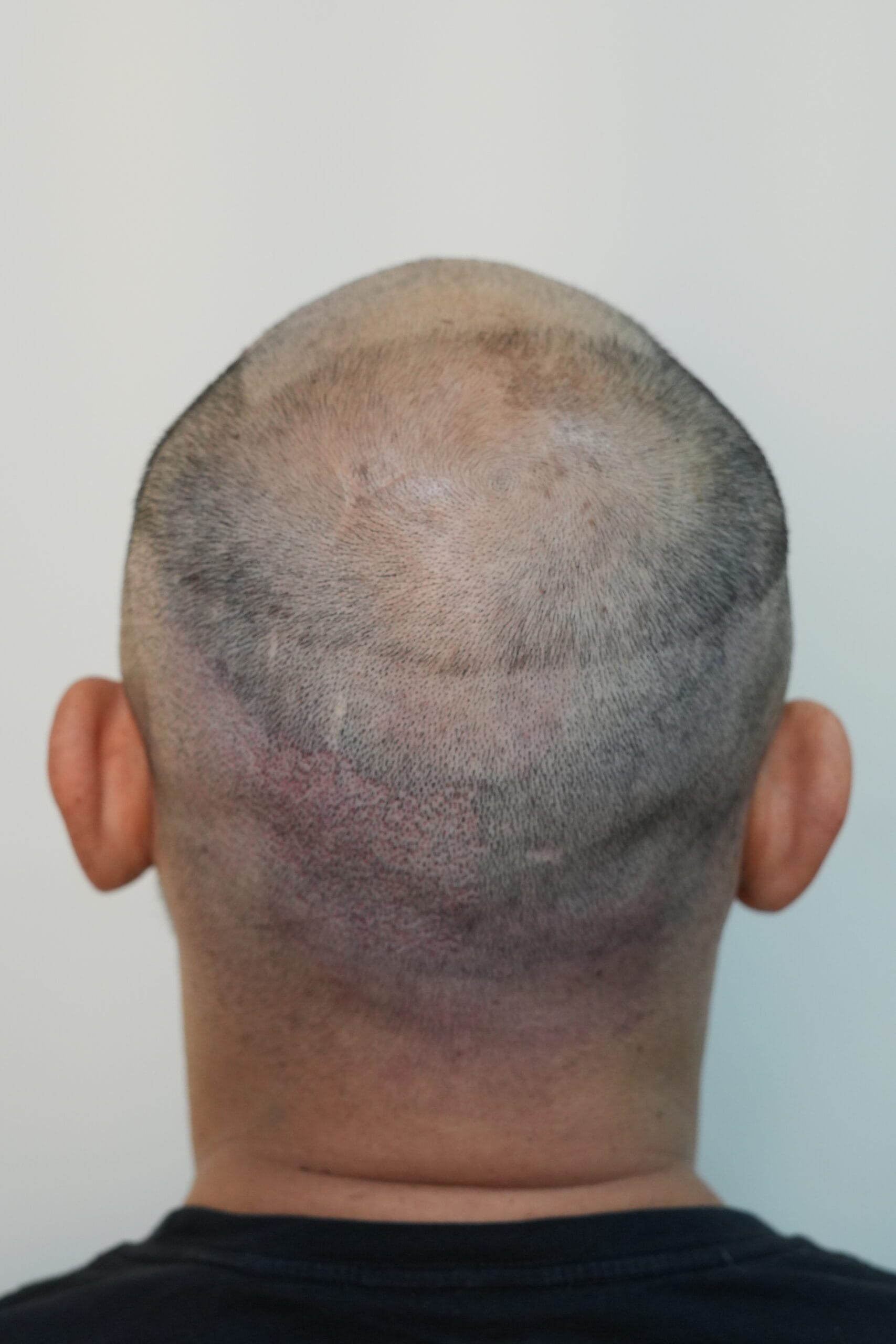 HST donor area hair transplant